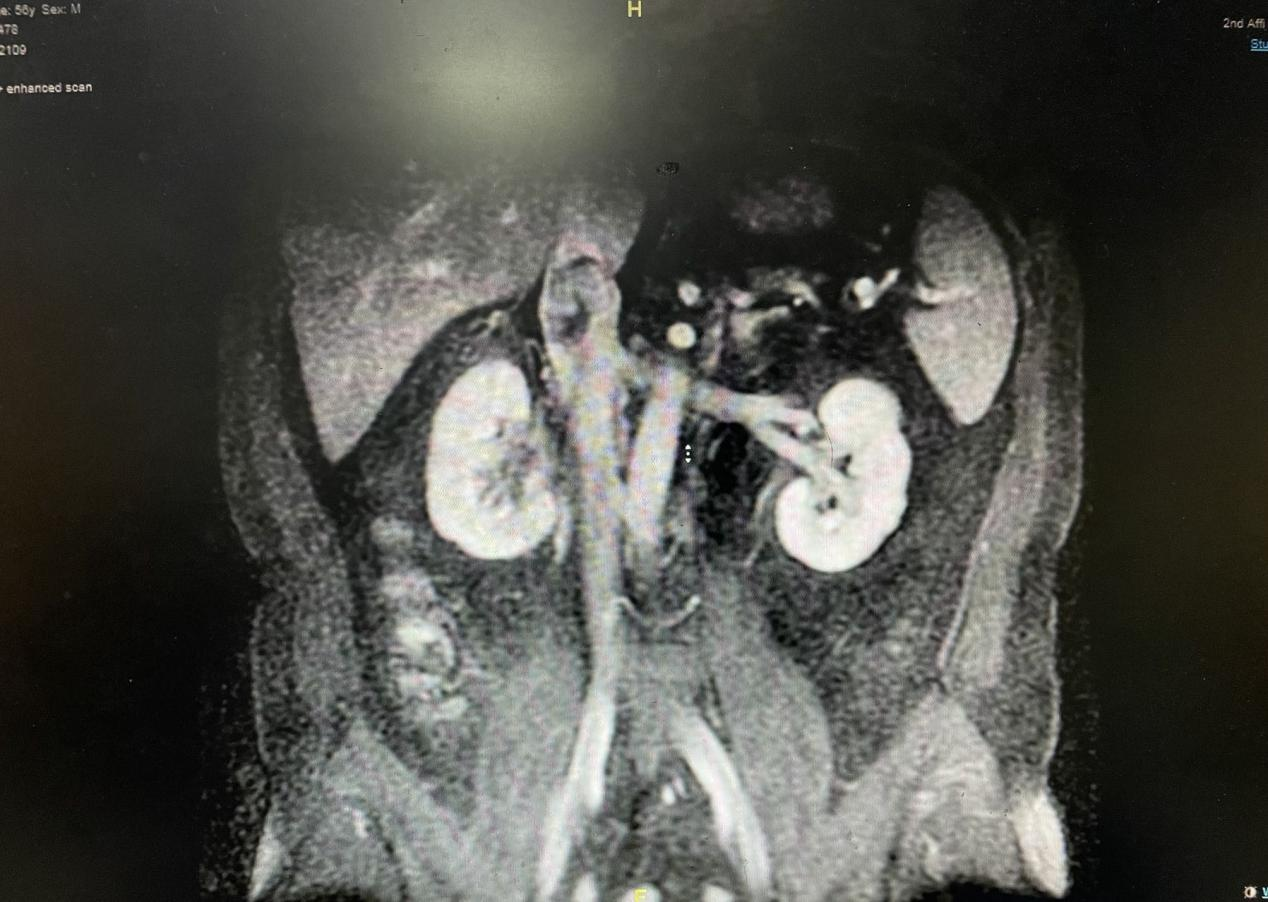 南昌大学二附院泌尿外科成功完成一例肾癌根治+下腔静脉 II 级癌栓取出术