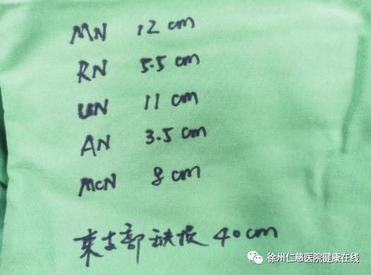 臂丛神经缺损，手术 11 小时，共移植 182.7 厘米神经