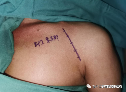 臂丛神经缺损，手术 11 小时，共移植 182.7 厘米神经