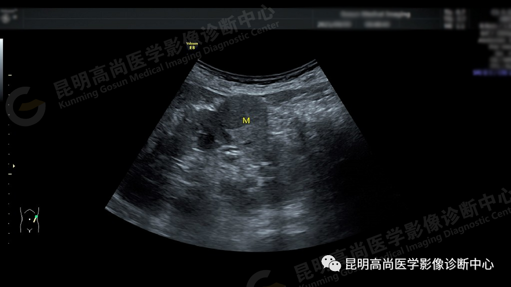 高尚病例:63 岁女性日常无症状,体检发现左肾癌