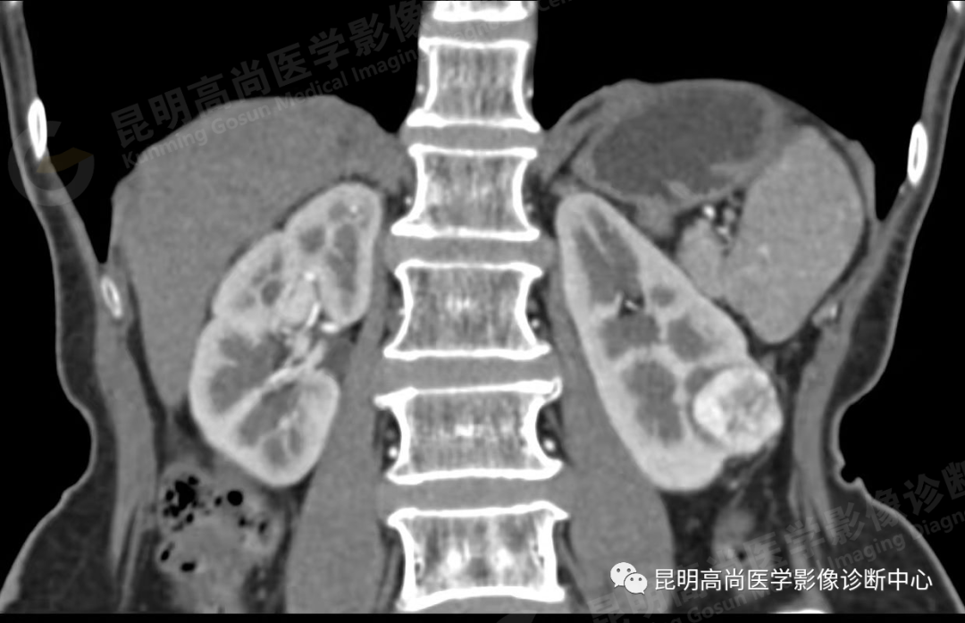 高尚病例:63 岁女性日常无症状,体检发现左肾癌