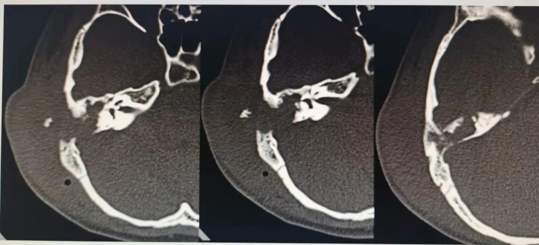 喀什地区第一人民医院成功开展首例耳内镜下中耳胆脂瘤切除术