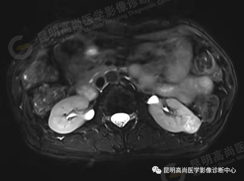 高尚病例:63 岁女性日常无症状,体检发现左肾癌