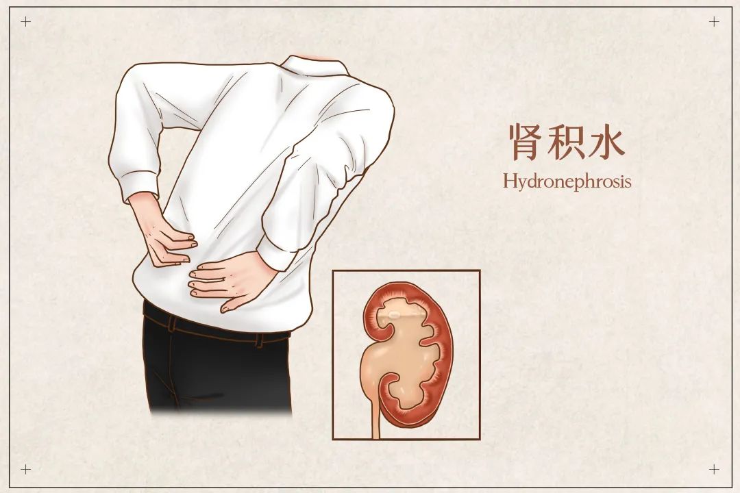 年轻小伙憋尿 6 小时致膀胱被憋爆：每天都在憋尿？当心憋出这 9 种病来！
