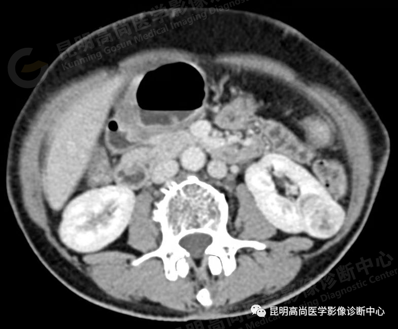 高尚病例:63 岁女性日常无症状,体检发现左肾癌