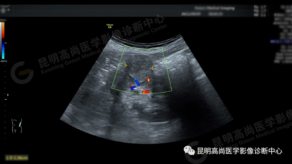 高尚病例:63 岁女性日常无症状,体检发现左肾癌