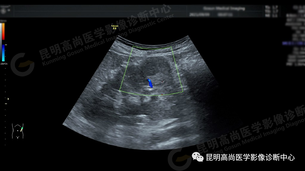 肾癌超声图片