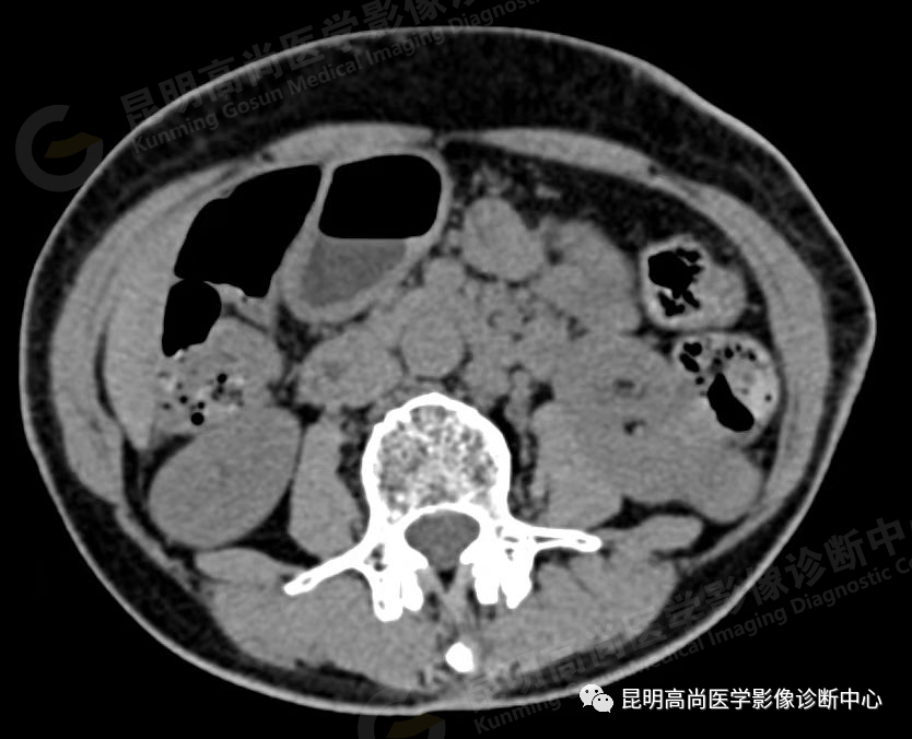 高尚病例:63 岁女性日常无症状,体检发现左肾癌