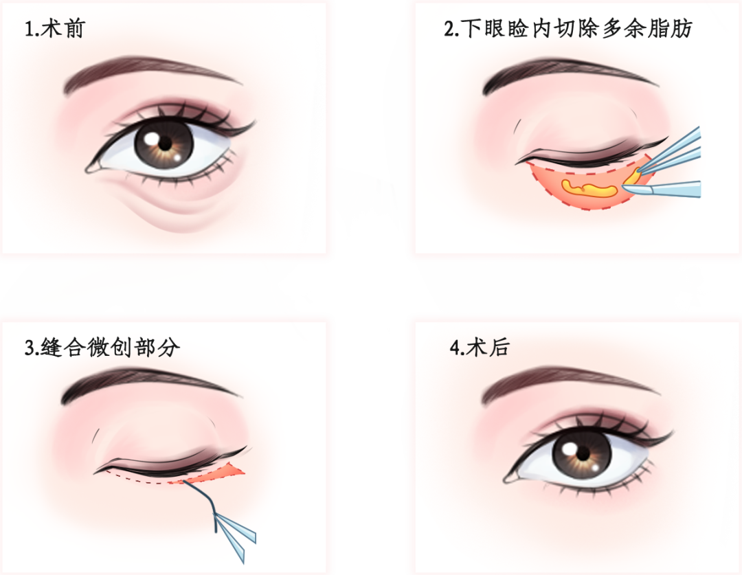 北京眼袋泪沟：关于眼袋、泪沟一次性讲清楚 - 知乎
