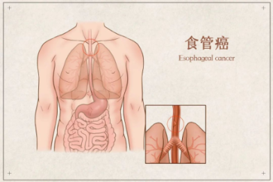 全球食管癌近一半在我国，有患者从确诊到离世仅 1 个月！