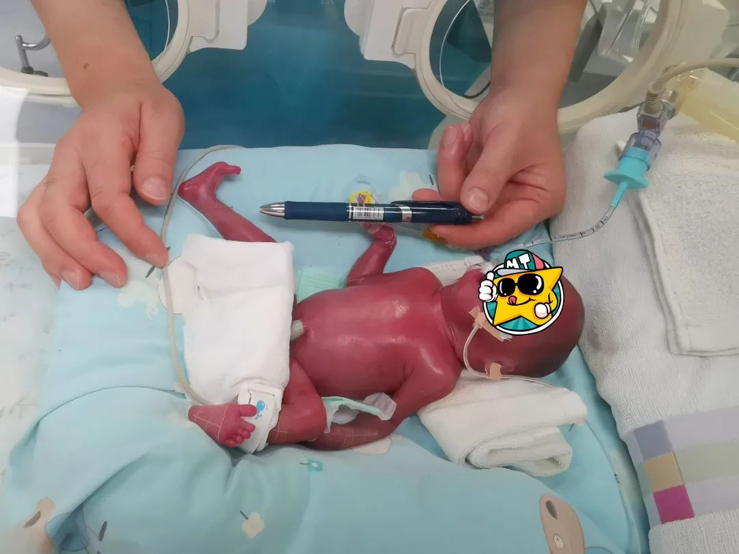 快！23 周早产！1.4 斤的「巴掌宝宝」生命闯关！