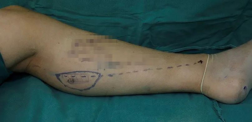 喀什地区第一人民医院成功开展南疆首例腓肠内侧动脉嵌合穿支皮瓣游离移植术