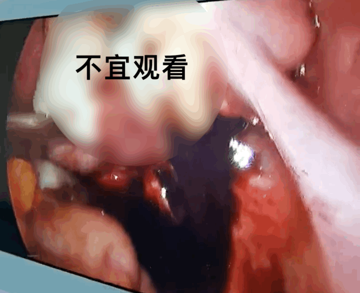 每次月经都痛得要死，25 岁女子竟一肚子「坏水」