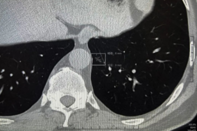 如何正确随访肺结节？记住这些点，千万别「睡」过头！