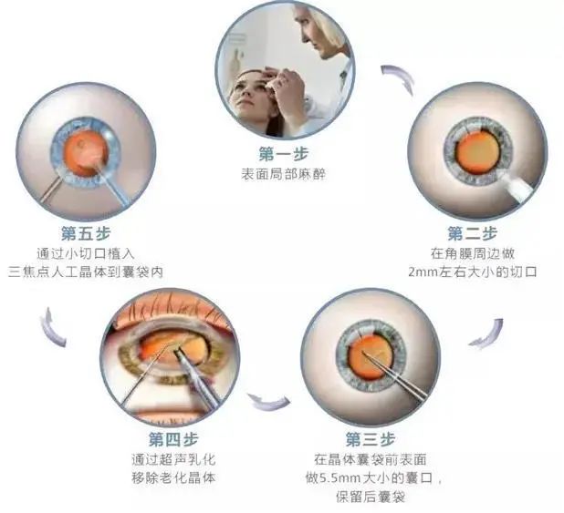 96 岁高龄，体重仅 27 kg！河源阿婆在深圳市眼科医院重获光明！