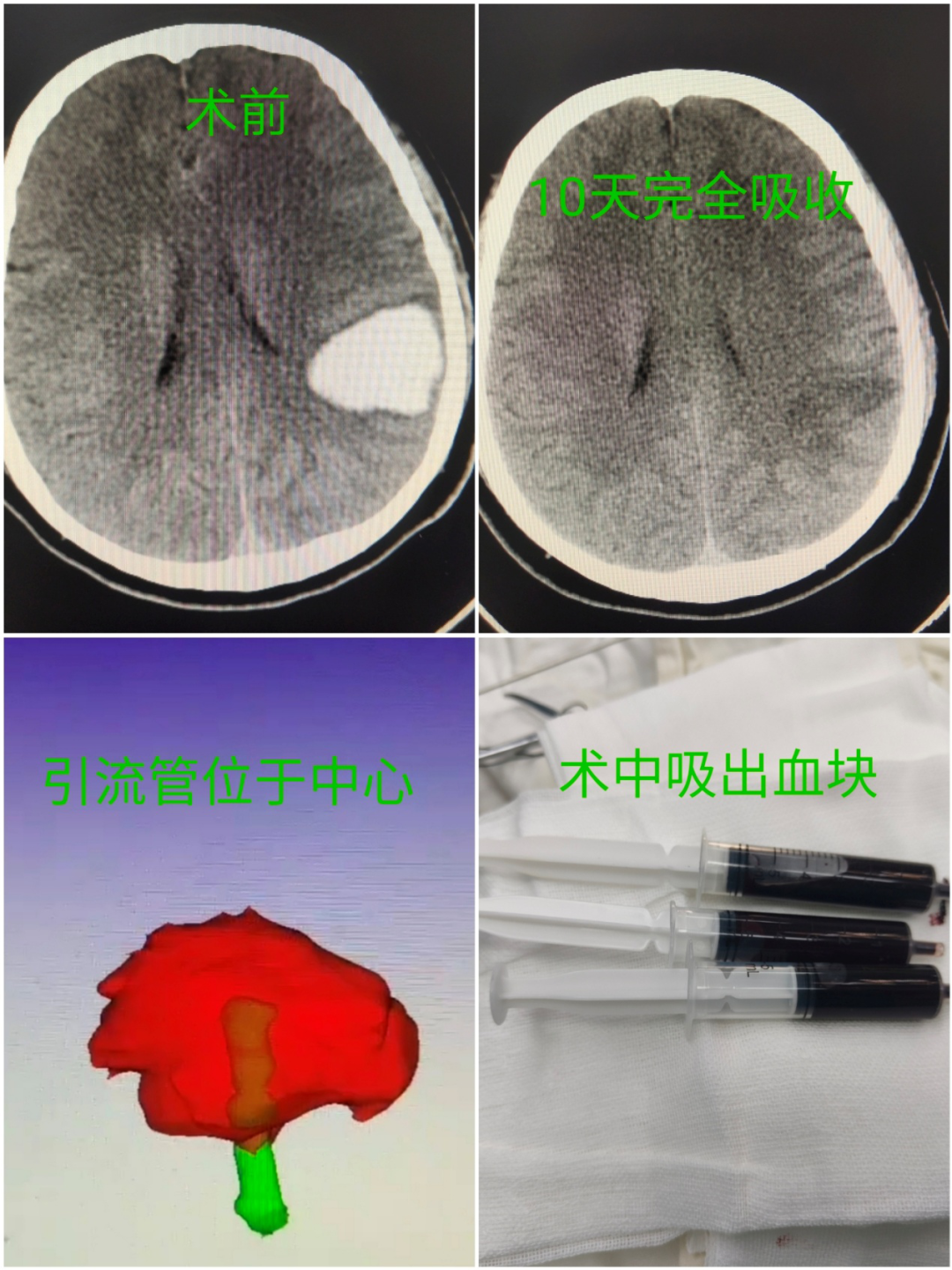 血肿钻孔图片