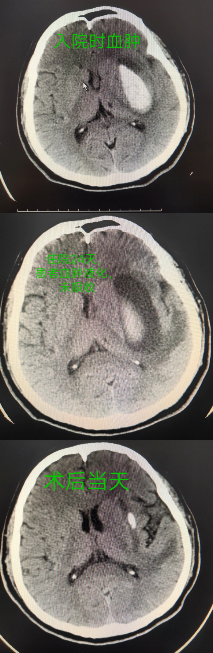 玉田县中医院脑病四科成功开展方体定位下颅内血肿钻孔引流术