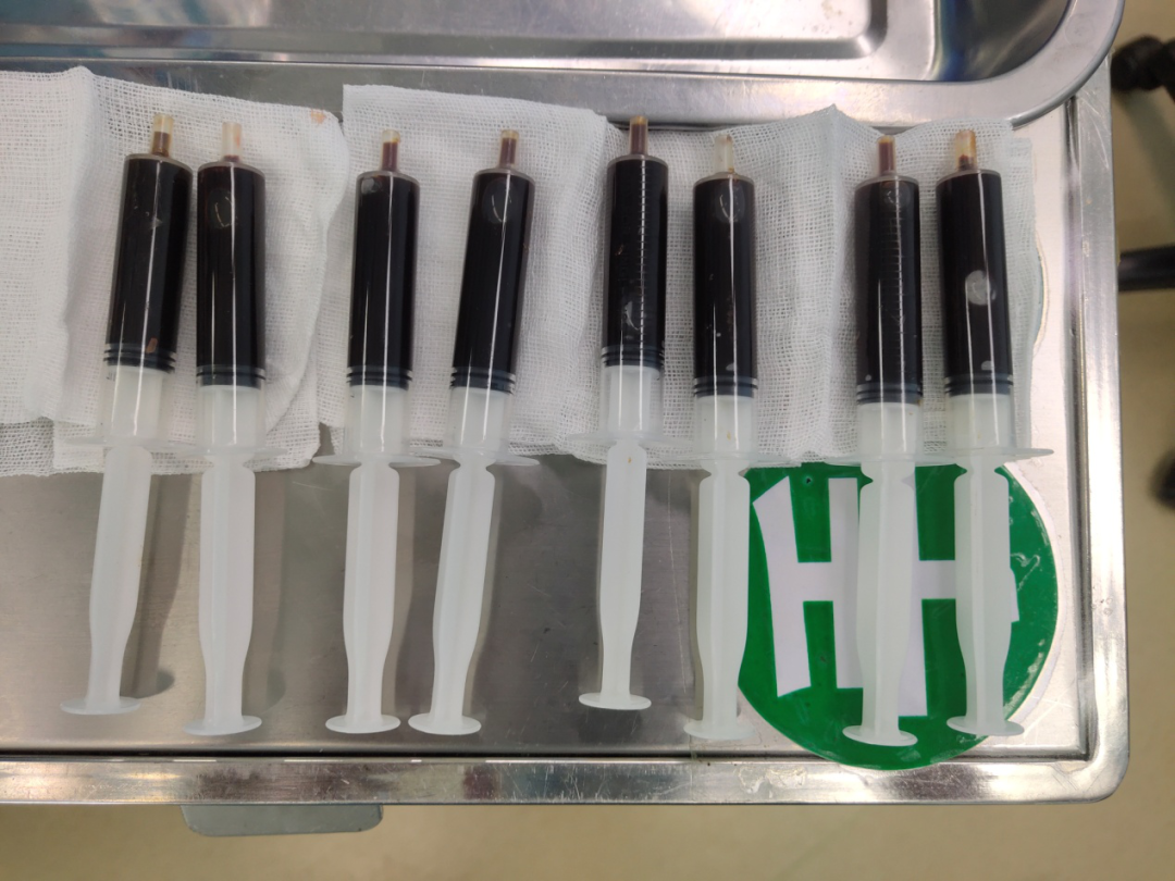 玉田县中医院脑病四科成功开展方体定位下颅内血肿钻孔引流术