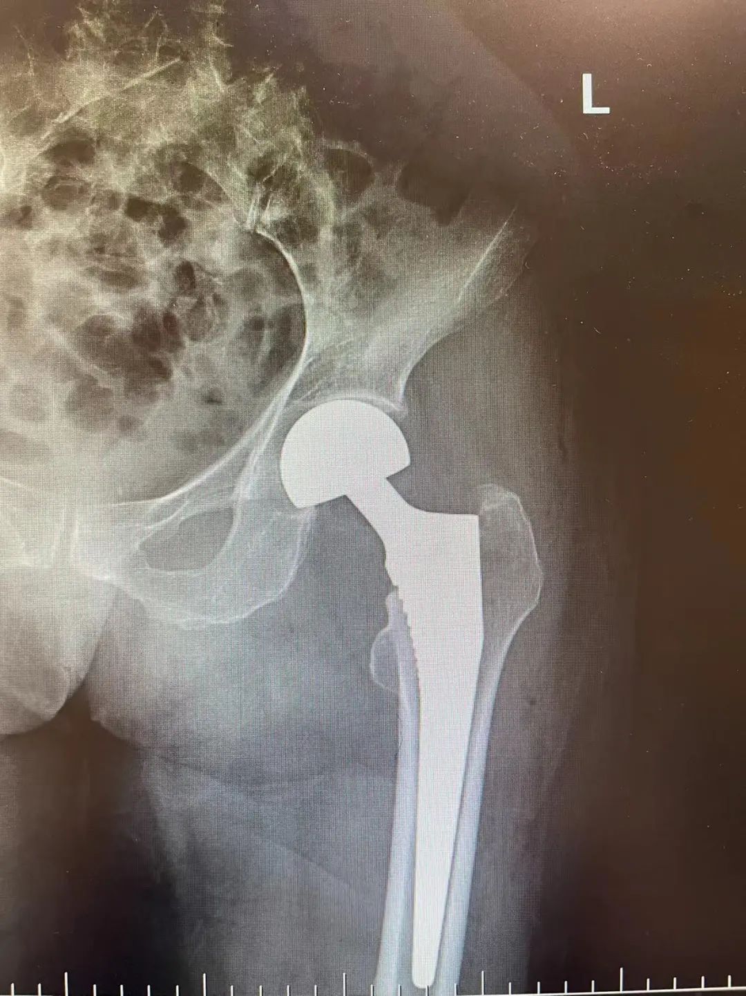 南京江北医院成功完成一例百岁老人髋部骨折人工股骨头置换术