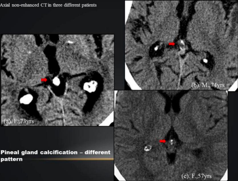包括松果體鈣化,脈絡膜叢鈣化,大腦鐮鈣化,基底節鈣化,小腦齒狀核鈣化