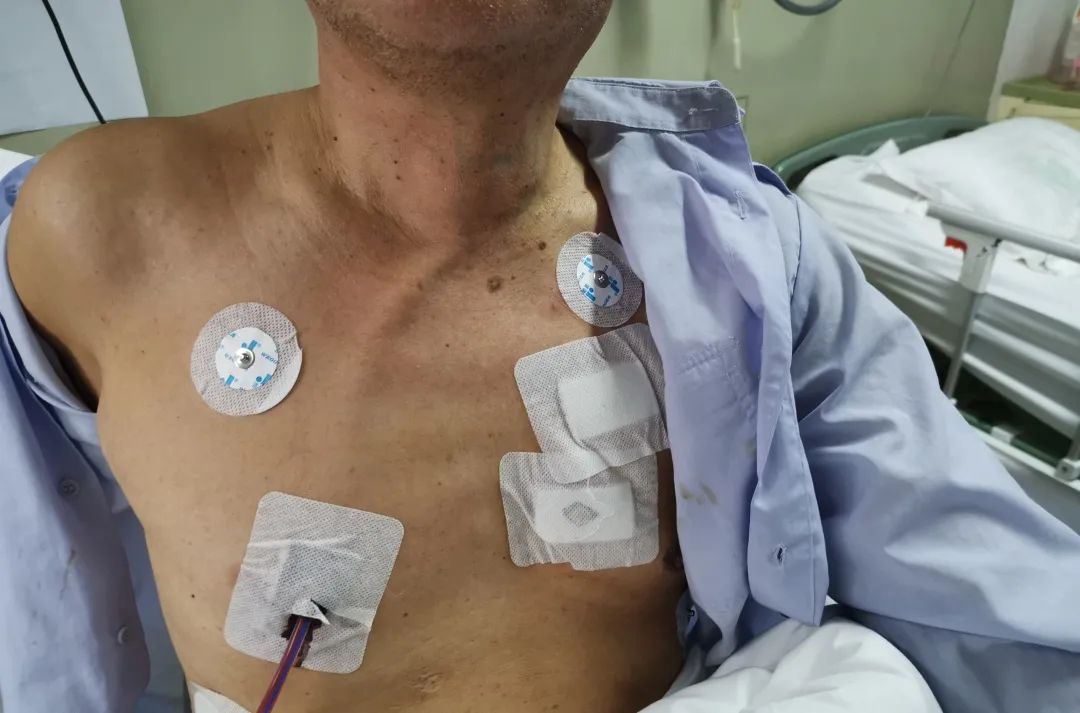 西安医学院一附院普通外科开展首例经口腔前庭腔镜甲状腺手术