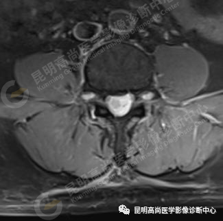 高尚病例：脊髓室管膜瘤一例