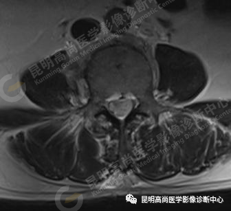 高尚病例：脊髓室管膜瘤一例
