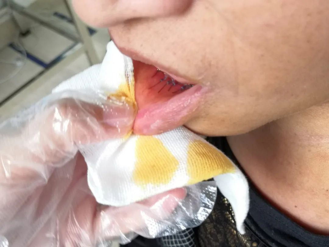 西安医学院一附院普通外科开展首例经口腔前庭腔镜甲状腺手术