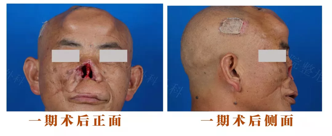 「没有鼻子」的老兵！整形外科替他「换了张脸」