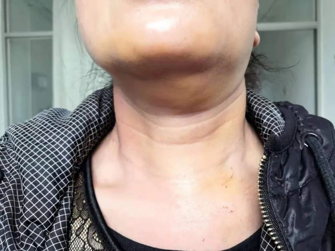 西安医学院一附院普通外科开展首例经口腔前庭腔镜甲状腺手术