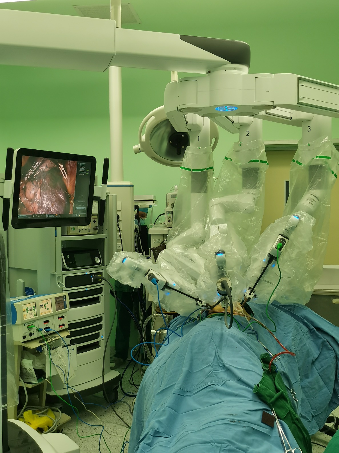 结直肠癌手术的另一种可能性！腹腔镜手术机器人不再高不可攀！-大比特商务网