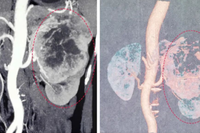 一边防控 一边救命| 西安大兴医院泌尿外科成功切除巨大肾肿瘤