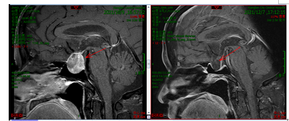 切除垂体瘤,神经内镜比显微镜更显「微」