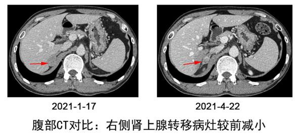 武汉大学人民医院肿瘤中心宋启斌教授团队探索出难治性甲状腺癌治疗新路