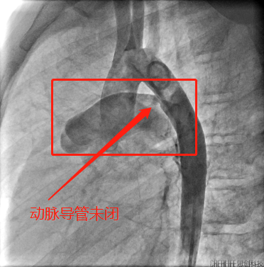 广西壮族自治区人民医院儿科用一次微创手术为患儿解决两种心脏畸形问题