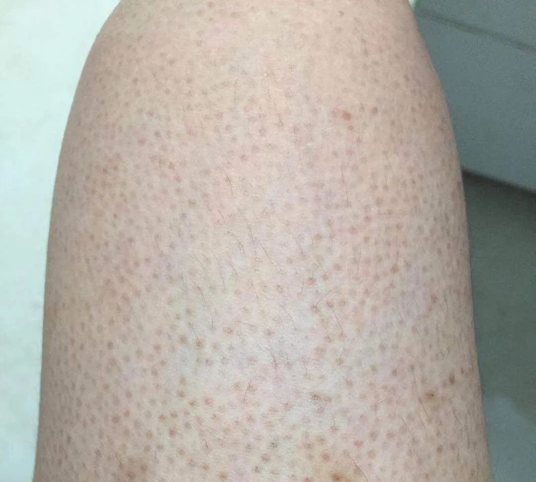 皮肤角化症会遗传吗?