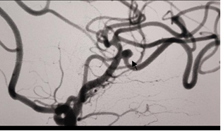 洗澡昏迷后被连夜送到医院手术！医生说，她脑子里长了三个东西……