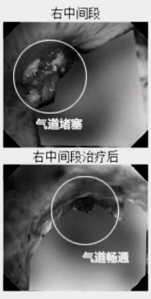 合肥京东方医院成功完成首例经电子支气管镜高频圈套新生物电切术