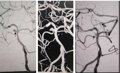 洗澡昏迷后被连夜送到医院手术！医生说，她脑子里长了三个东西……