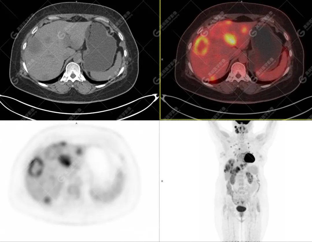 高尚病例：PET/CT 发现血管肉瘤多处转移 1 例