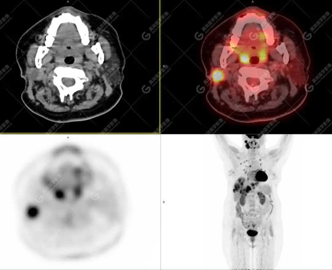 高尚病例：PET/CT 发现血管肉瘤多处转移 1 例