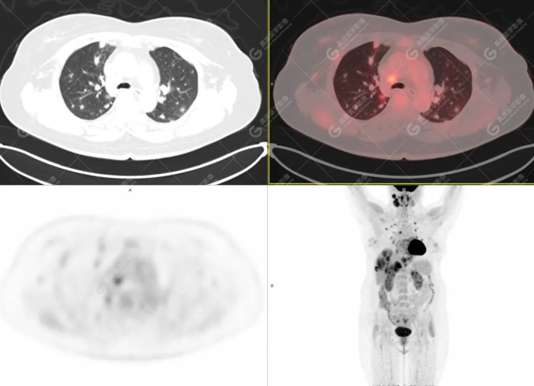 高尚病例：PET/CT 发现血管肉瘤多处转移 1 例