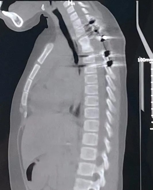 千万不要忽视儿童脊柱结核——同济大学附属同济医院救治一例瘫痪脊柱结核小病人