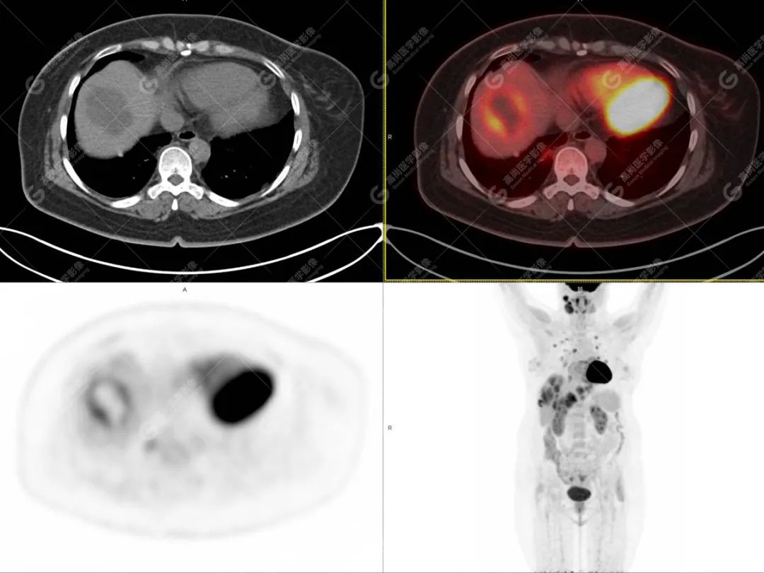 高尚病例：PET/CT 发现血管肉瘤多处转移 1 例