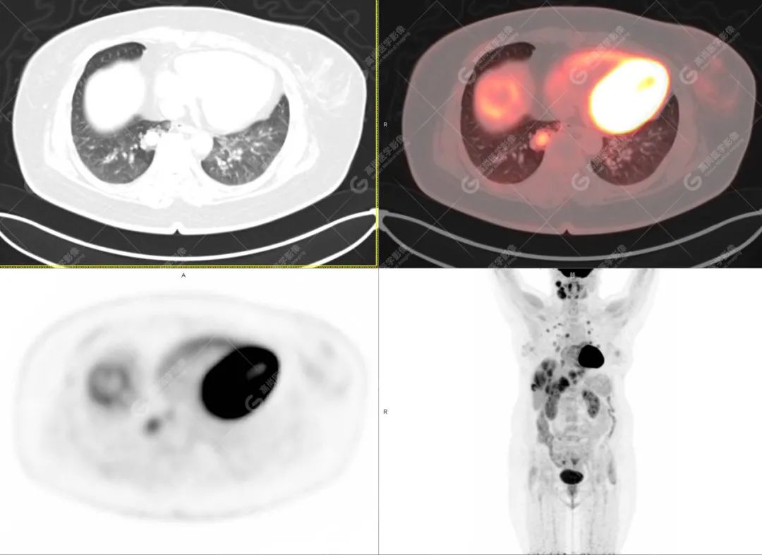 高尚病例：PET/CT 发现血管肉瘤多处转移 1 例