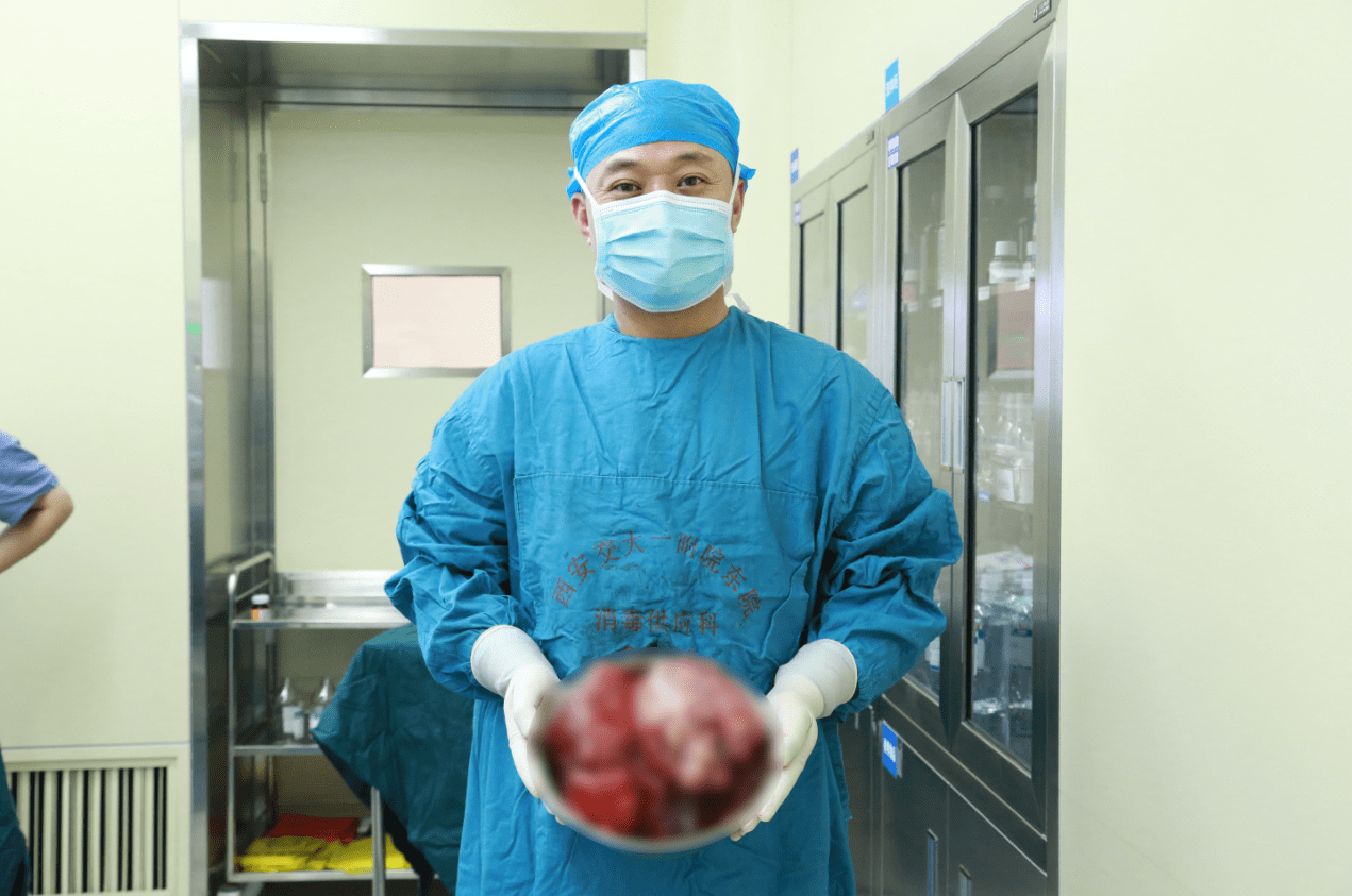 西安交大一附院东院区肝胆外科成功切除直径 25 公分巨大肝肿瘤