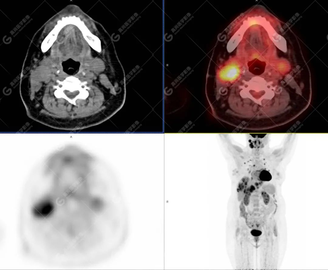 高尚病例：PET/CT 发现血管肉瘤多处转移 1 例