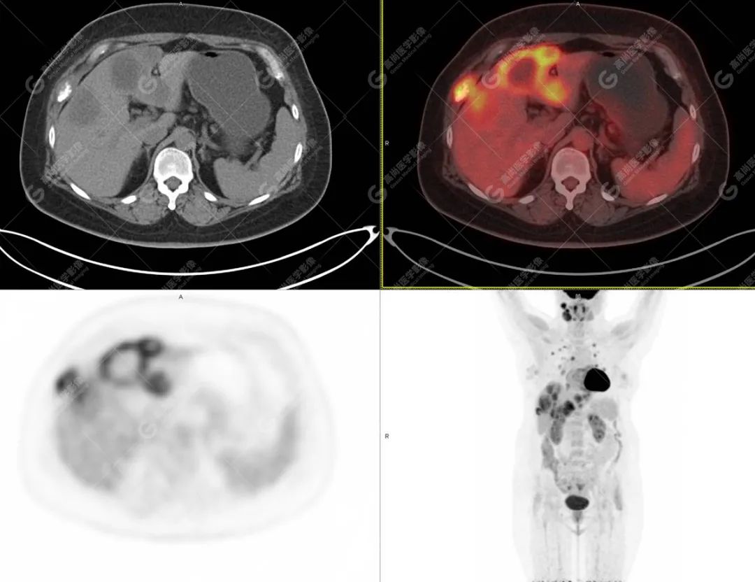 高尚病例：PET/CT 发现血管肉瘤多处转移 1 例