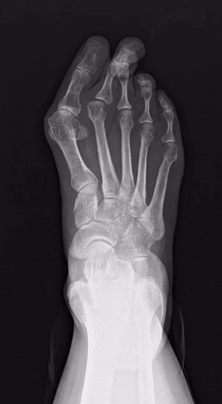 经常穿高跟鞋的你,要注意了!