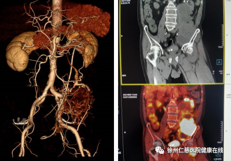 腹膜后恶性肿瘤复发,徐州仁慈医院多学科联合成功挑战手术